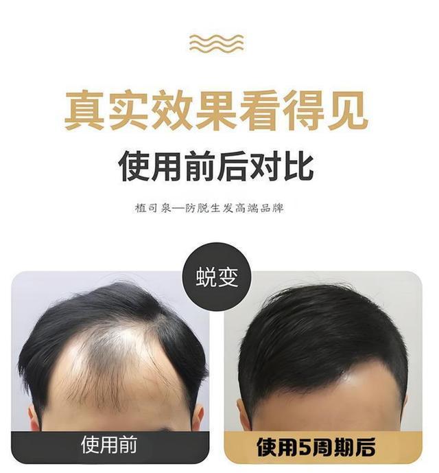 ？头顶脱发能治愈3-4 个月见证发量回归