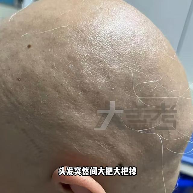 眉毛、腋毛30天内全部掉光！原因令人唏嘘……冰球突破豪华版手机版20岁女孩崩溃！头发、(图3)
